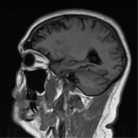 FTD MRI